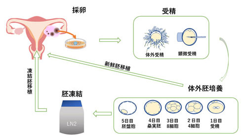 体外受精（IVF）のステップ