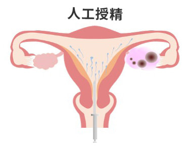 人工授精